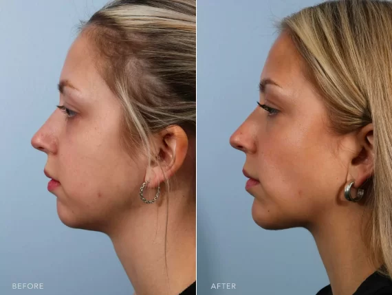 Jawline Exercises: Your Path to a More Defined and Attractive Face